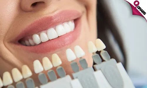 Direct Composite Veneers & Flouride Teeth Varnish!